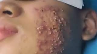 His Face Acne  Blackhead  Blackhead Removal on forehead  Remove Blackhead [upl. by Auhsaj]