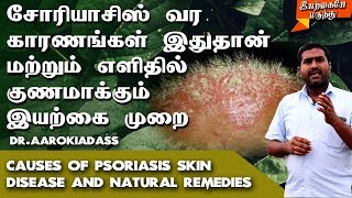 சோரியாசிஸ் பிரச்சனைக்கு நிரந்தர தீர்வு  Psoriasis Natural Treatment Tamil  Skin Disease Treatment [upl. by Dutch32]