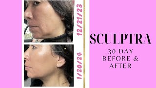 Sculptra 30 Day Before amp After 2 Vials collagen sculptra [upl. by Malley778]