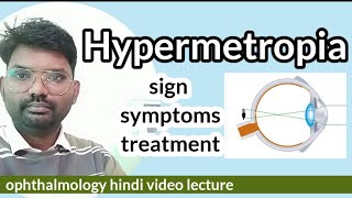 hypermetropia  what is hypermetropia  hypermetropia symptoms  optometryhindispecial  eye [upl. by Cornel]