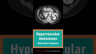 Hypervascular Metastases Differential Diagnoses  Radiology Tutorials  video 61 [upl. by Audras]