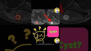 Fig 4D19 Schwannoma [upl. by Reneta80]