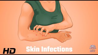 Skin Infections Uncovered What Your Dermatologist Wants You to Know [upl. by Hsak895]