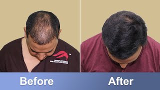 Hair Transplant in Hyderabad  Best cost and best results By India’s top surgeon [upl. by Radbourne]