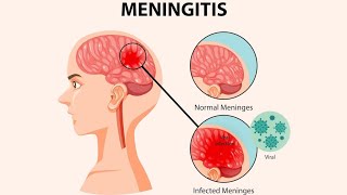 Meninges  Meningitis symptoms Diagnosis And Treatments [upl. by Janet]