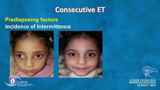 Consecutive ET after BLR recession in Intermittent Exotropia [upl. by Ahsiki]