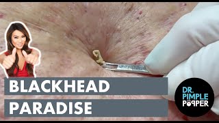 Blackhead Paradise [upl. by Arrehs]