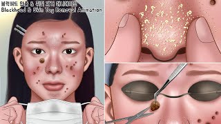 ASMR 피지 폭발 마스크 속 뒤집어진 피부 케어하기  블랙헤드 압출 ＆ 쥐젖 제거 애니메이션  blackhead ＆skin tag removal animation [upl. by Norvil]