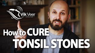 How to Cure Tonsil Stones [upl. by Aubine957]