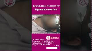 QSwitch Laser Treatment for Facial Pigmentation [upl. by Stockmon]