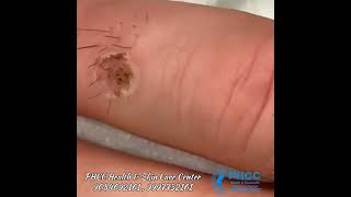 Warts Aur moles skin Tags Se paye chutkara   5 mint main  warts  Skintags  Moles skincare yt [upl. by Petronilla584]