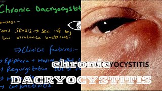 Chronic Dacryocystitis  lacrimal system [upl. by Maxfield553]