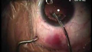 RLE Katarak Cataract Surgery [upl. by Neemsay]