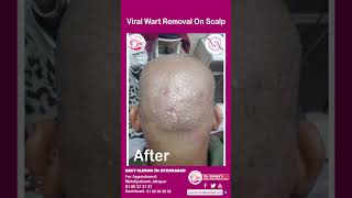 Viral Wart Removal On Scalp  Scalp Wart Removal Treatment  Dr Vimalas Skin Hair amp Laser Centre [upl. by Releehw953]