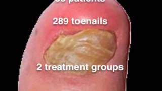 Nail Lacquer Shown Effective for Toenail Fungus [upl. by Auqemahs807]