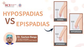 Hypospadias vs Epispadias  Dr Gautam Banga  SCI Hospital [upl. by Vahe]