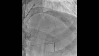 Manual Thrombus Aspiration is still needed in STEMI [upl. by Xaviera961]