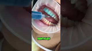 Carillas Vs Brackets dientes dentista tips parati viral fyp shorts shortvideo fypシ [upl. by Nytsirt]