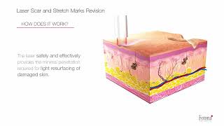 Fotona Laser Scar and Striae Revision [upl. by Beaufert]