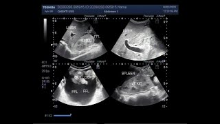 Ultrasound Video showing Ascites Gall Bladder Sludge and Hepatic and Renal parenchymal disease [upl. by Anileh]