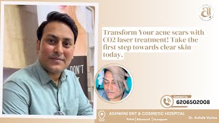 CO2 Laser Treatment Your Complete Guide to Youthful Skin Dr Achala Verma [upl. by Nnylannej]