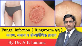 Ringworm Fungal Infection Complete information [upl. by Lyndon]