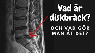 Vad är diskbråck och vad gör man åt det [upl. by Halland]