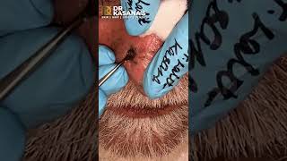 Nose Blackheads  Removal by DrLalit Kasana [upl. by Attevroc]