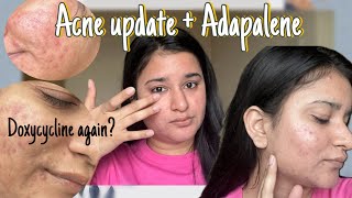 Why did i get acne back after 2 yrs of Tretinoin Acne update  Part 5 [upl. by Klug]