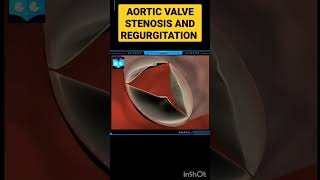 Aortic Valve Stenosis And Regurgitation  Animation  shorts Biology [upl. by Udella]