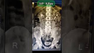 IVP XRay All Image Explane short viral medical student trending 🏥 [upl. by Gar]