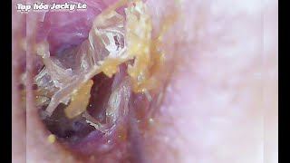 Ear Wax Removal 102 Ear Canal Is Deep And Infected With Yeast Causing Itching  Ear Cleaning ASMR [upl. by Roberta933]