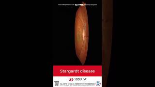 Stargardts Disease retinaspecialist retinadystrophyretina eyeeducation eyes eyespecialist [upl. by Devol]