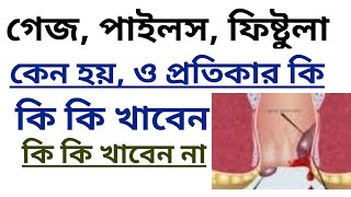 গ্যাজ রোগের চিকিৎসা । piles treatmenthemorrhoids treatmentpiles treatment at homepiles problem [upl. by Uehttam]