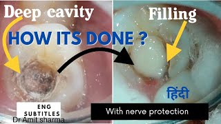 How Deep cavity filling done with nerve protection  pulp capping  Treatment of sensitive cavities [upl. by Ettezyl]