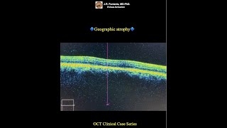 Geographic atrophy Atrophic agerelated macular degeneration [upl. by Eimilb516]