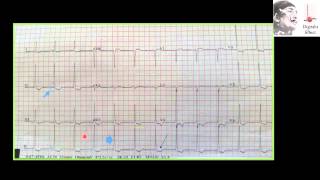 digoxin effect toxicity [upl. by Ruff880]