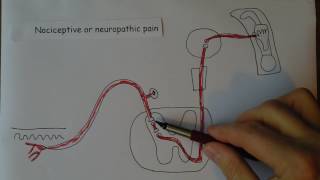 Neuropathic pain [upl. by Ordway]