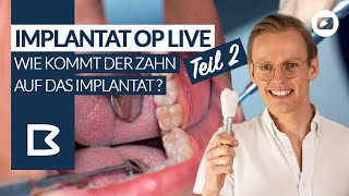 Zahnimplantat LIVE einsetzen  Teil 2  Wie kommt die Zahnkrone auf das IMPLANTAT [upl. by Naut36]