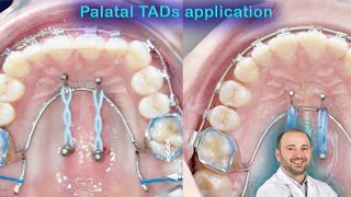 Wide range of palatal TADs applications mini screws palatelly benefits of mini implants in palate [upl. by Loggia357]