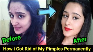 How to Remove Pimples Acne Pimple Marks completely  ThatGlamGirl [upl. by Eitsirc]