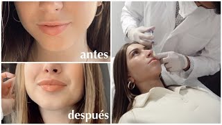 ME INYECTO ÁCIDO HIALURÓNICO EN LOS LABIOS  experiencia antes vs después  CARLOTAGONZALEZ [upl. by Body]