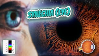 Synechia eye Your EYEBALLS 👁️👁️💉😳💊🔊💯✅ [upl. by Allyn]