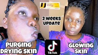 VIRAL TIKTOK TRETINOINACNESOL TREATMENT FOR ACNEWHAT YOU NEED TO KNOWTHE GOODTHE BAD amp THE UGLY [upl. by Aratak]