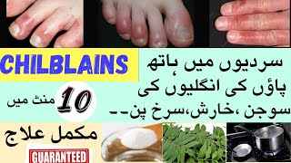 Itchy Toes and Fingers In Winters  CHILBLAINS دس منٹ میں سوجن، خارش کا علاج۔۔ Swollen hands [upl. by Amle322]