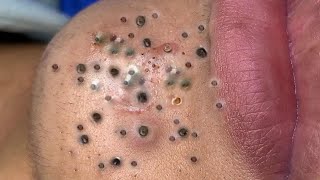 Big Cystic Acne Blackheads Extraction Blackheads amp Milia Whiteheads Removal Pimple Popping  2212 [upl. by Yahc522]