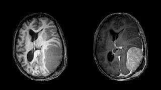 Tumor embolization  Embosphere [upl. by Mohl]