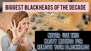 Nasty and lengthy blackhead removal bent needle historical method DrAMAZINGSKIN [upl. by Hgieloj]