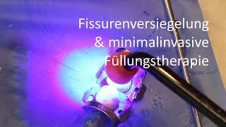 Fissurenversiegelung und minimalinvasive Füllungstherapie [upl. by Atsirtal]