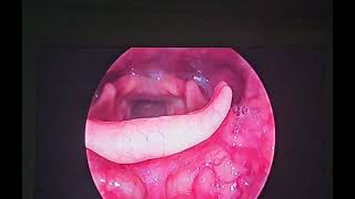 laryngeal papilloma papillomavirus hoarseness cough entsurgeon drbaisalisarkar kolkata [upl. by Yadsendew]